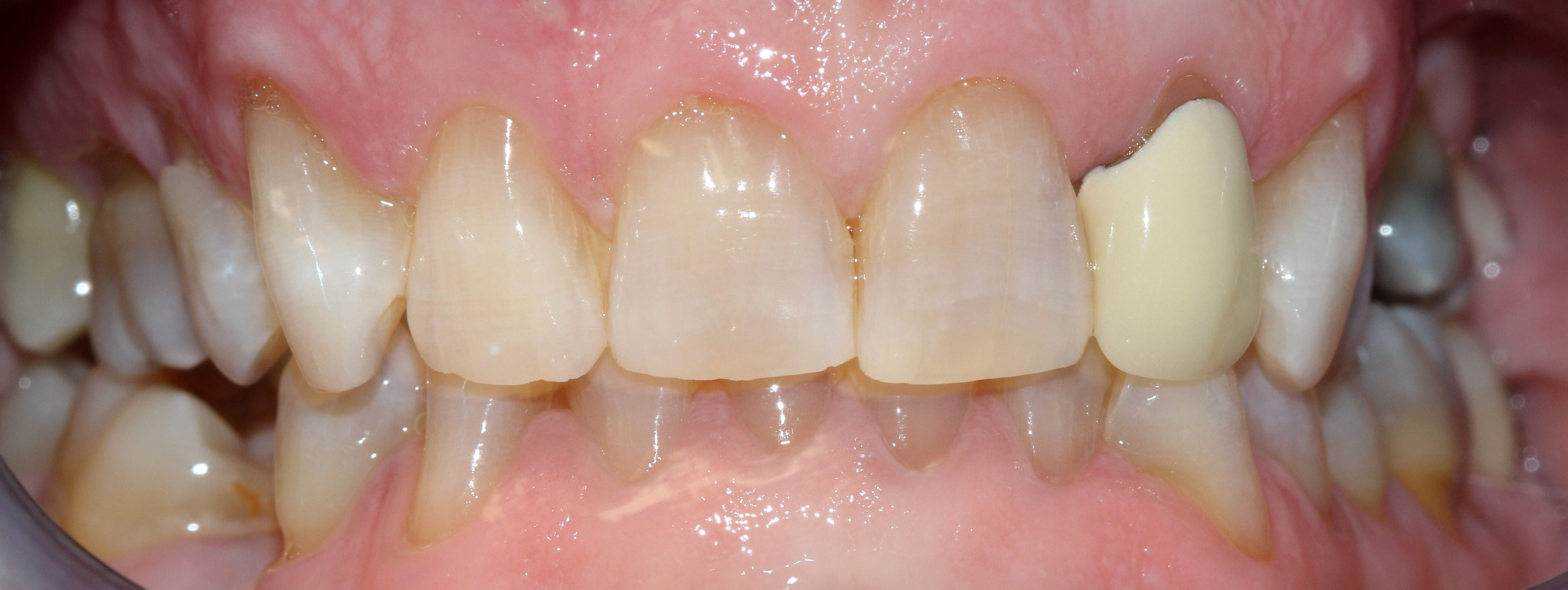 After picture, showing whiter teeth.