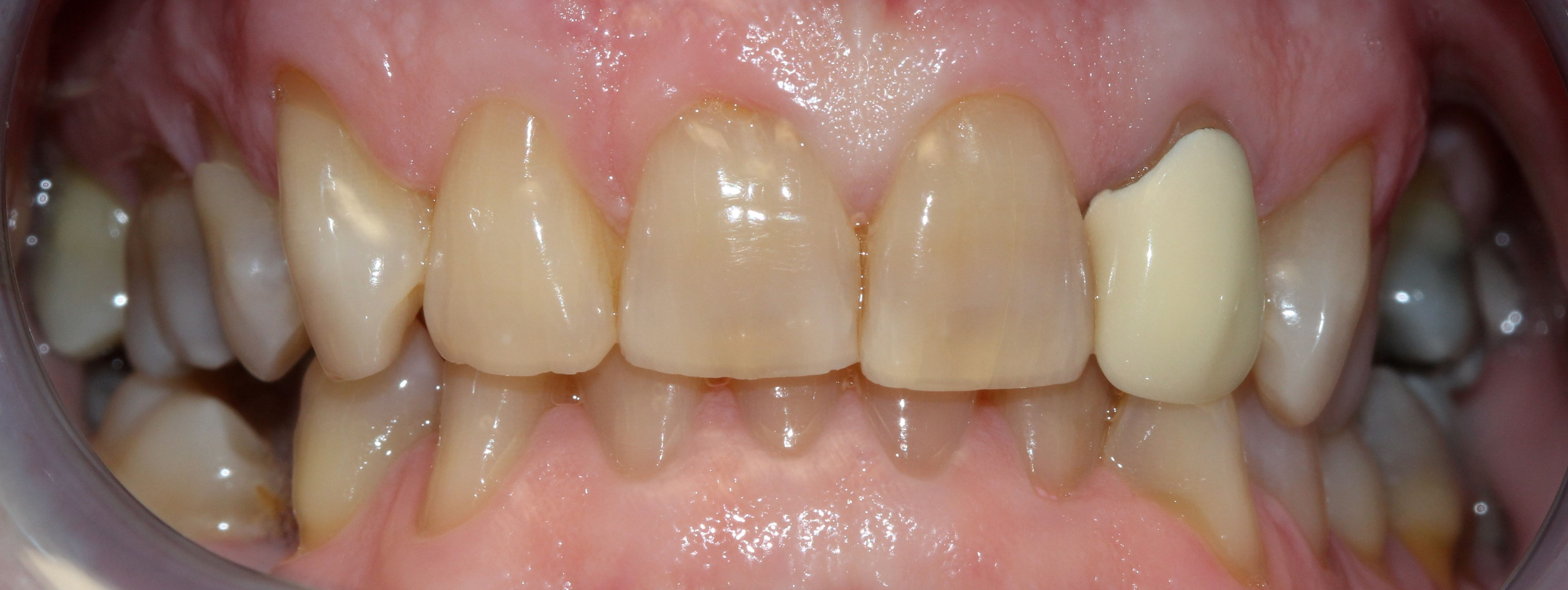 Before picture of teeth, looking slightly discolored.